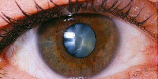 650x350_cataracts_overview_slideshow